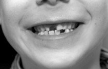 Denti da Latte e permanenti